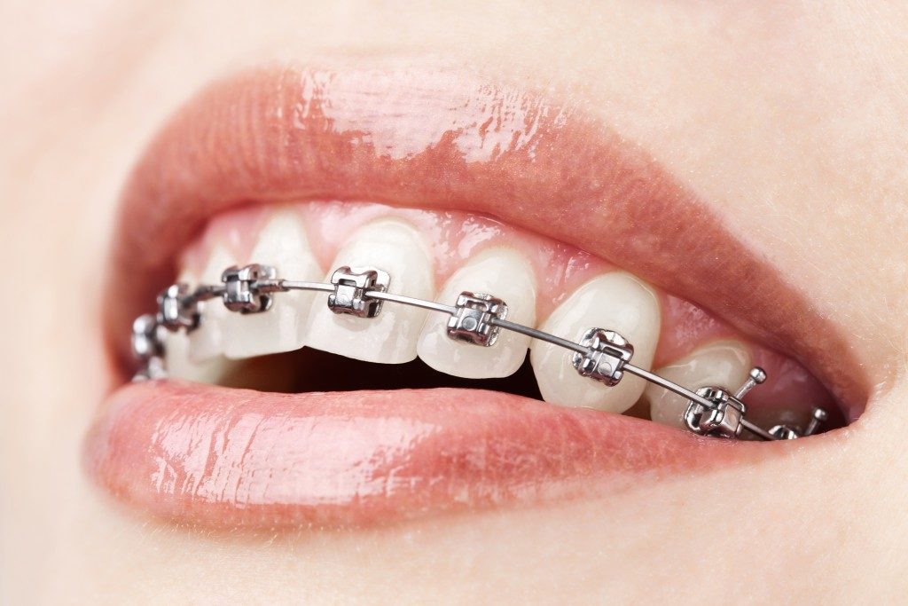 person wearing braces